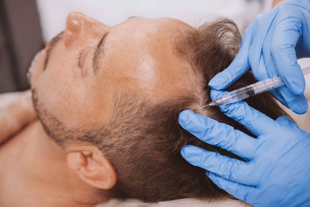 doctor performing scalp injection on male patient with hair loss