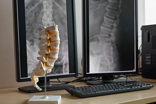 Artificial human lumbar spine model on the table in front of a display monitor of lumbar spine x-rays for Miami Spine and Sports Doctor's website