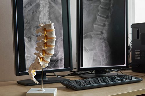 A computer monitor with some human spine model on it