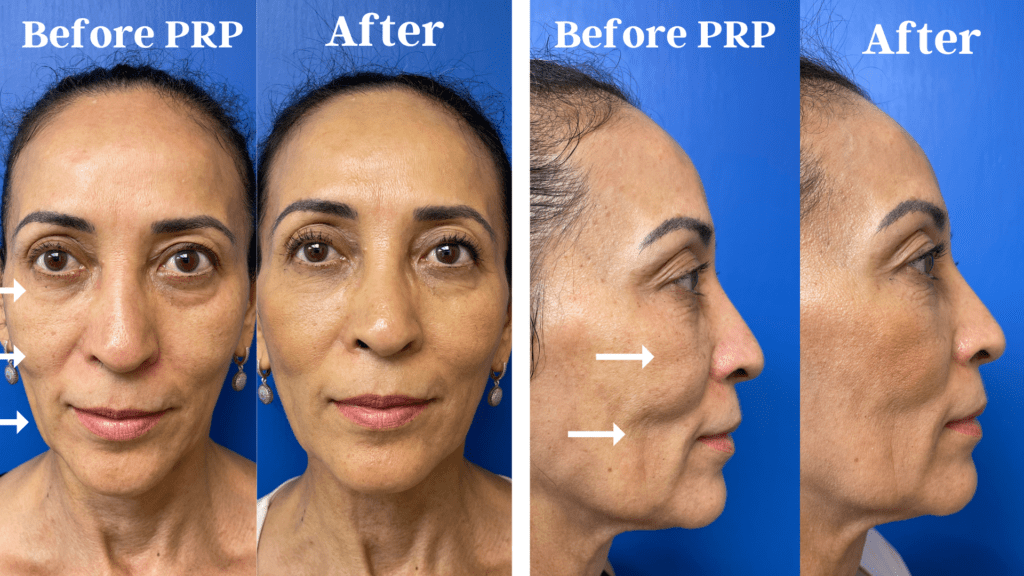 A woman's face before and after Facial Rejuvenation in Miami.