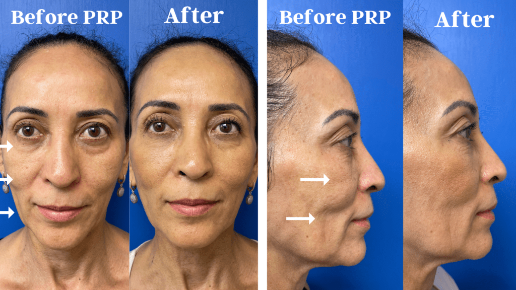 A woman before and after prp treatment.