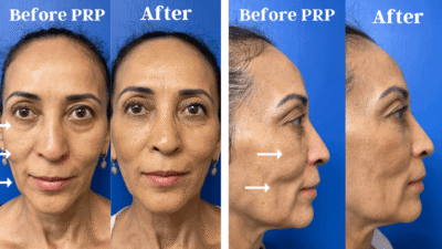 Frontal face comparison showing PRP results