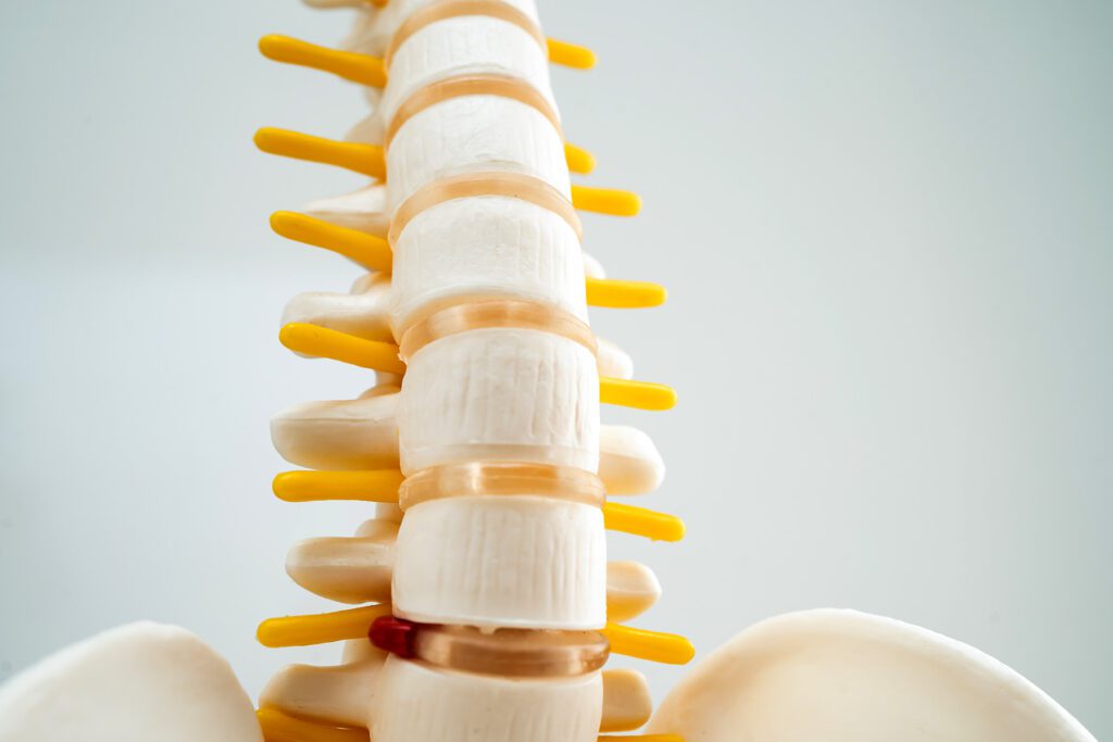 A close up of a model of the spine demonstrating spinal fractures.